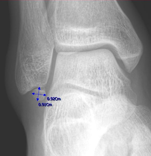 (반야월 정형외과) 비골하 부골(os subfibulare)로 인한 갑작스런 발목 통증 : 네이버 블로그