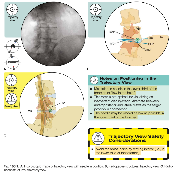 Lumbar Transforaminal Epidural Steroid Injection, TFESI (Infraneural ...