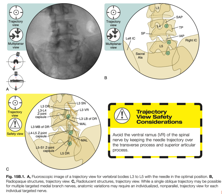 요추 내측분지 차단술 (Lumbar Medial branch block, MBB) : 네이버 블로그