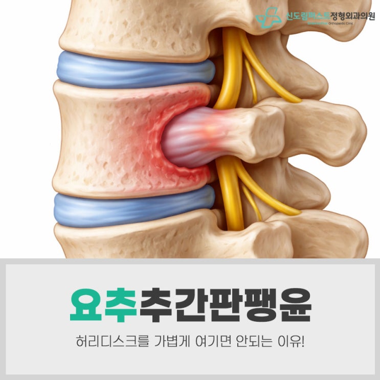 요추 추간판 팽윤, 허리디스크를 가볍게 여기면 안되는 이유 : 네이버 블로그