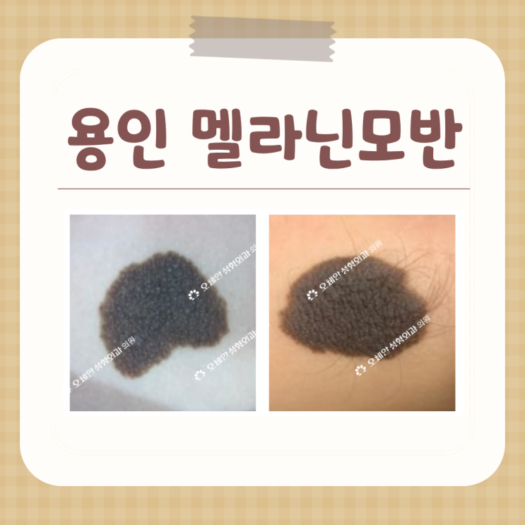 용인 멜라닌모반 치료는 외과적 수술로 선천성 모반 큰점 제거해요 : 네이버 블로그