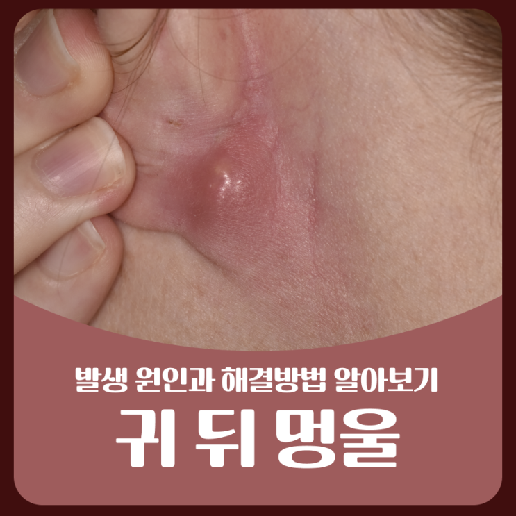 귀 뒤 멍울 원인과 해결 방법에 대하여 : 네이버 블로그