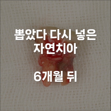 치아재식술 경과 텅 빈 뼈가 차오른 6개월