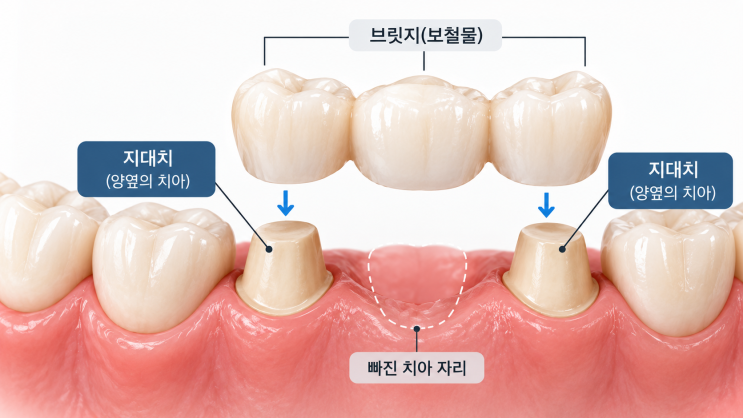 孝昌洞歯科、古いブリッジも再治療できますか？再補綴前に確認すべきこと