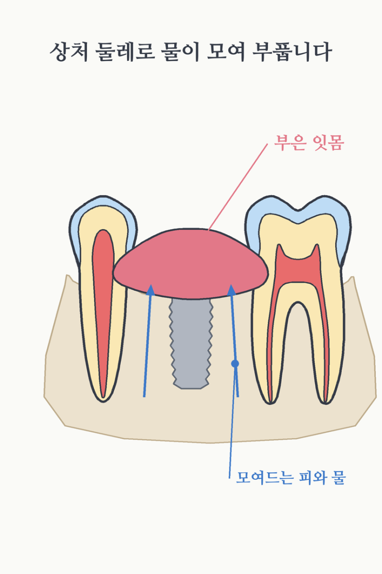 임플란트통증, 며칠이면 가라앉고 편해질까요? : 네이버 블로그