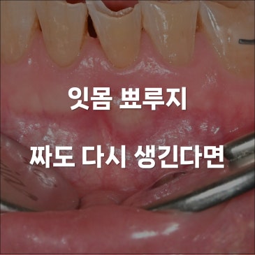 잇몸 뾰루지 원인 짜도 다시 생긴다면