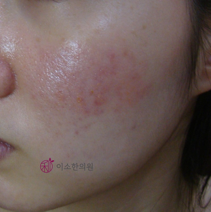 프로게스테론자가면역피부염(Progesterone Hypersensitivity), 생리 전 가려움, 피부염 : 네이버 블로그