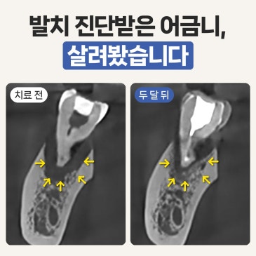 치근단 농양, 발치 진단받은 어금니 살려봤습니다
