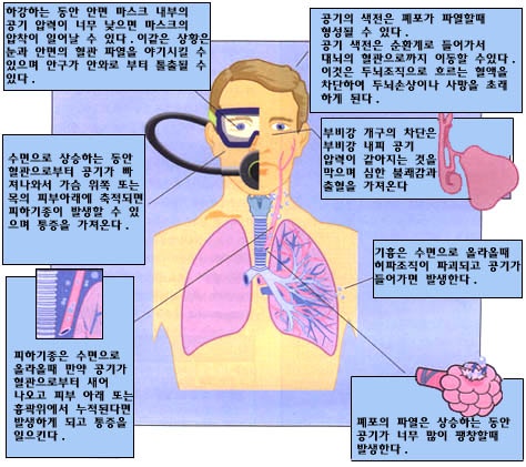 11 공기 색전증(Air Embolism) : 네이버 블로그