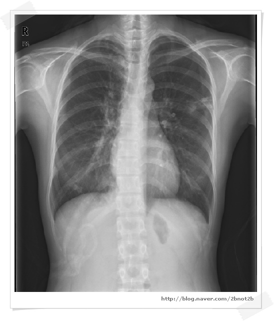 활동성 폐결핵(Active pulmonary tuberculosis) : 네이버 블로그