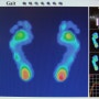 평발ㅣ성장통ㅣ족부스캔 족압분석 강남수재활의학과