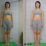 X다리, 비만, 척추측만증 교정 치료전후 비교사진